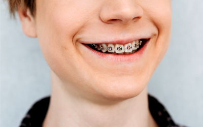 Malocclusione dentale: cause, conseguenze e soluzioni